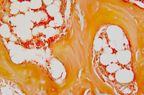 BoneMarrowDiseasesshare BoneMarrowDiseasesshare