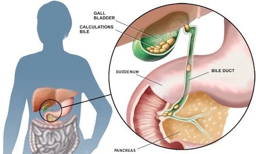 Biliary colic Biliary colic