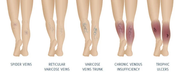 Venous insufficiency